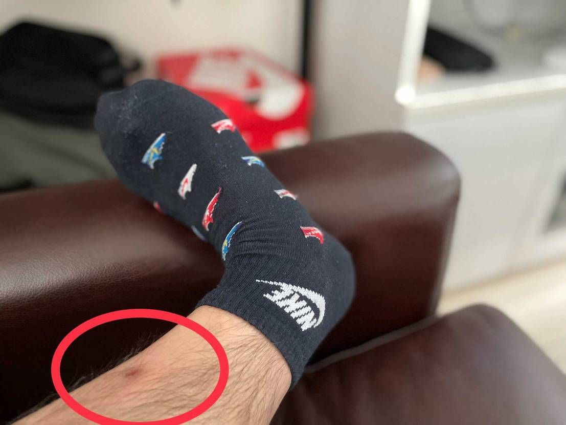 汚い足でスミマセン。
ダニに噛まれたあと🤣
ダニ　ノー！
スネ毛　いん！